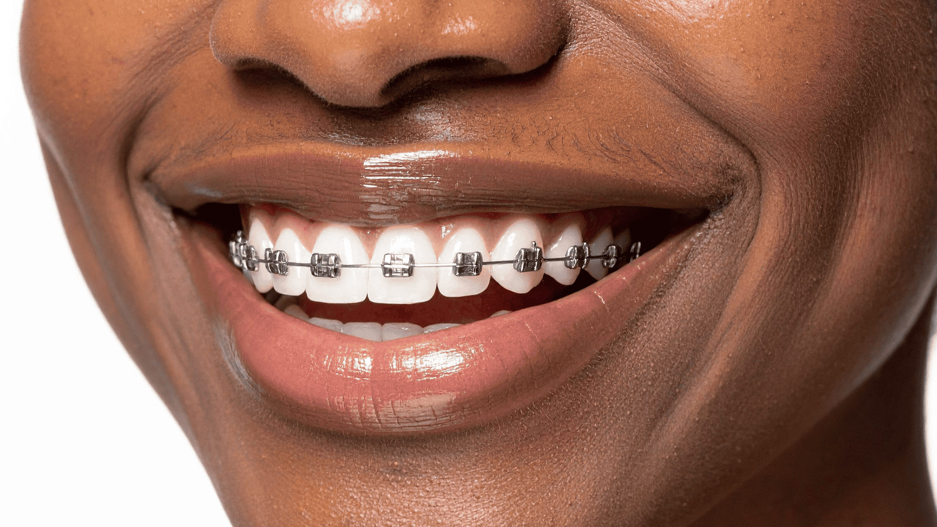 Looking for braces in Oxnard, CA? Lifetime Dental Care provides orthodontic care for the whole family. Flexible payment options and military discounts. Book your consultation today.