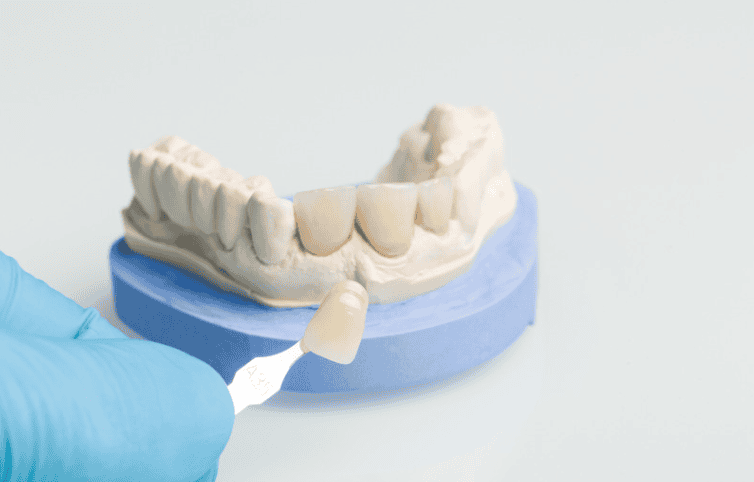 Need a dental crown in Oxnard, CA? Lifetime Dental Care offers custom crowns for front and back teeth at three convenient locations. Affordable pricing and military discounts. Book today.