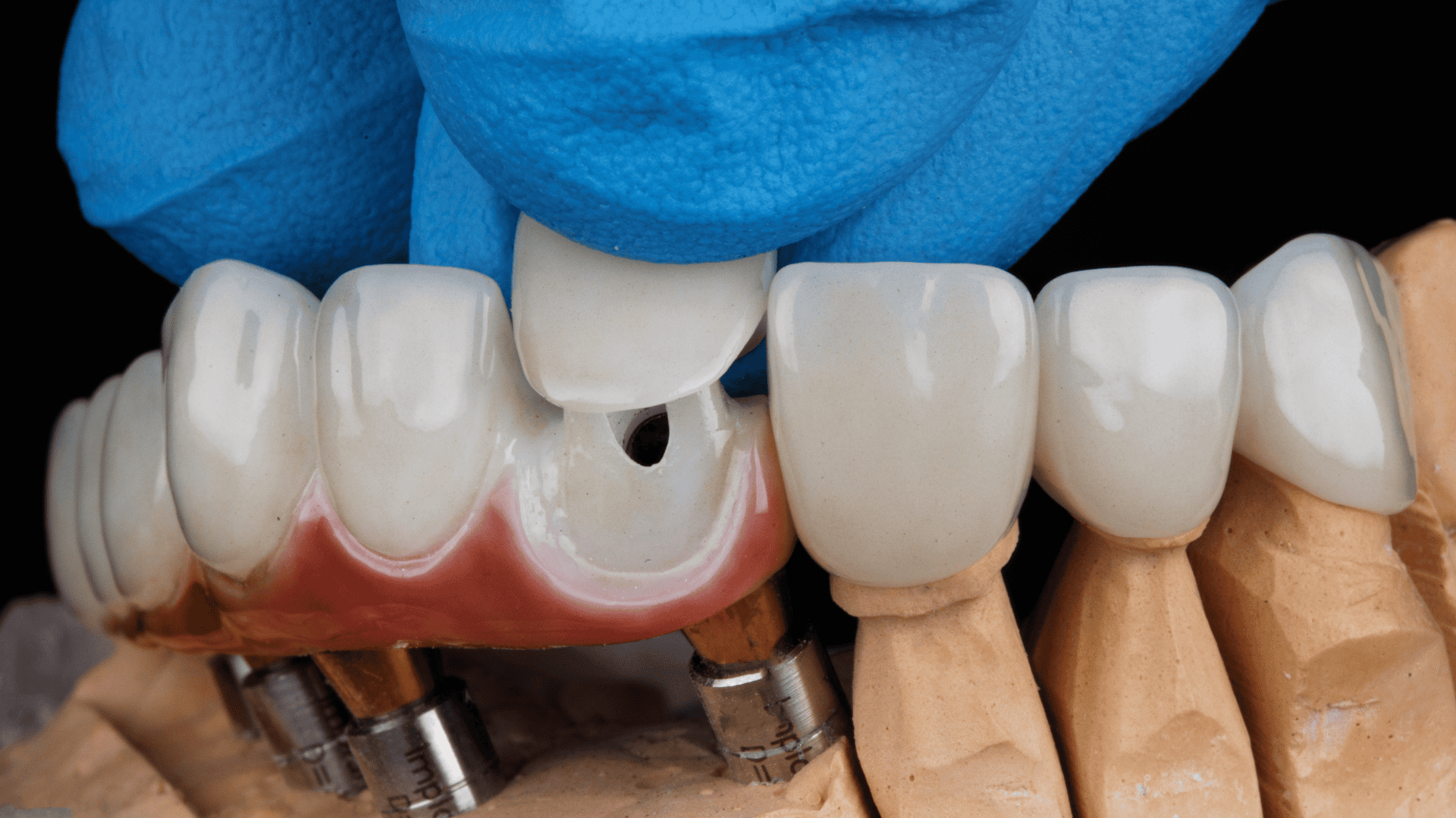 Dental Crowns in Oxnard & Santa Paula | Lifetime Dental Care