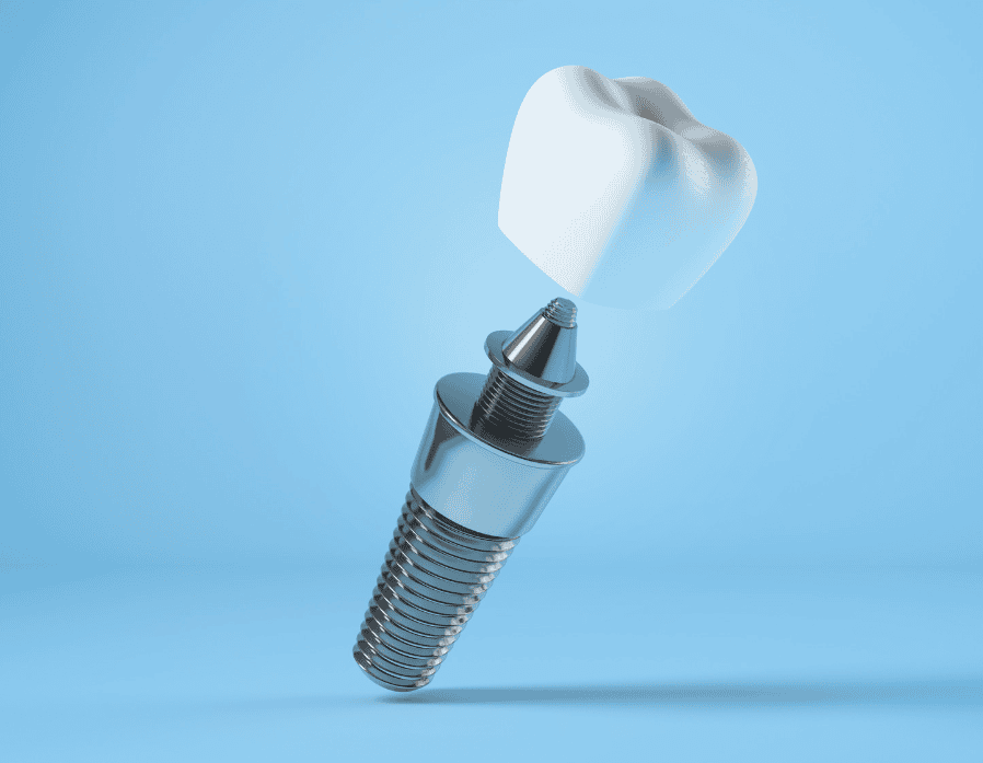 Professional dental implant treatment at Lifetime Dental Care. Permanent, natural-looking tooth replacement in Oxnard and Santa Paula. Three locations. Accepting new patients.