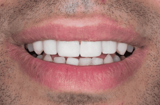 Dental implants in Oxnard and Santa Paula. Permanent tooth replacement including single implants and All-on-4 full arch restorations.