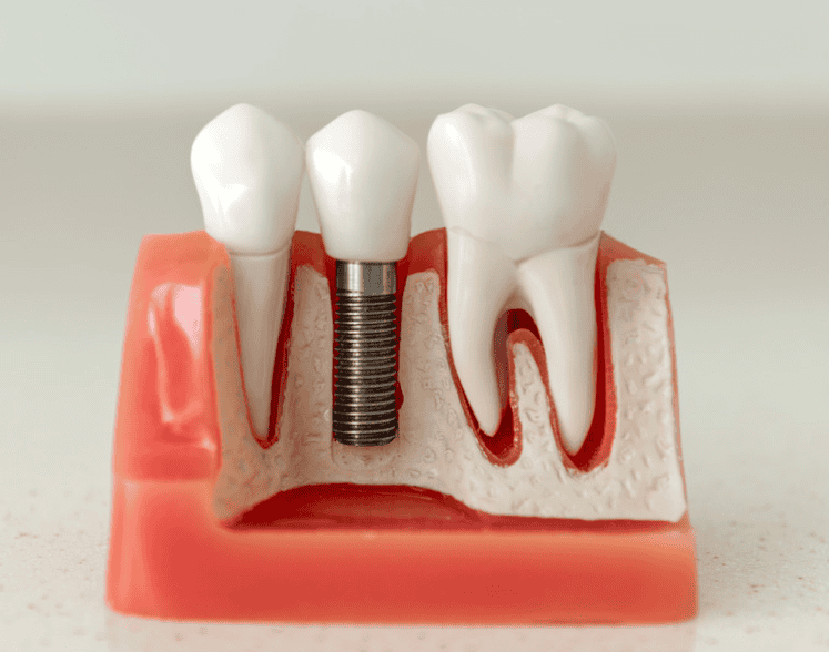 Missing teeth? Lifetime Dental Care provides dental implants in Oxnard, CA. Single tooth implants and full arch options. Affordable payment plans and military discounts. Book your consultation.