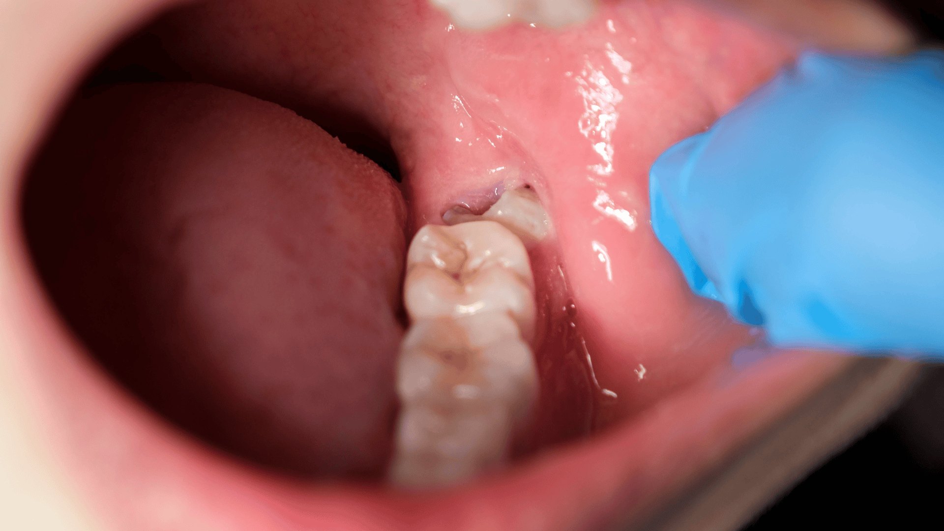 Wisdom Teeth Removal in Oxnard & Santa Paula